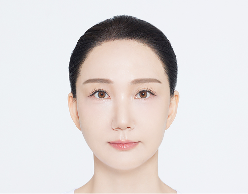 Non-incision hair transplant after