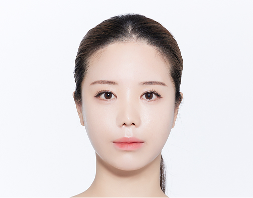 Non-incision hair transplant before