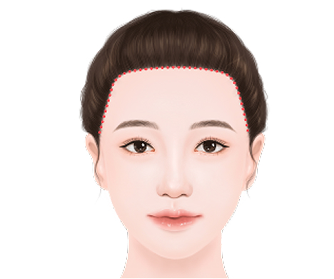 Angular forehead