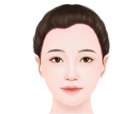 Asymmetrical forehead