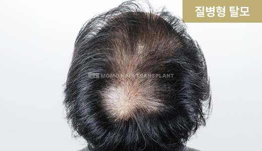 질병형 탈모