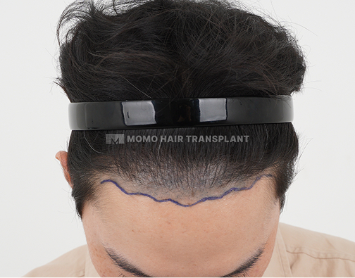 Forehead reduction scar cover incisional hair transplant before