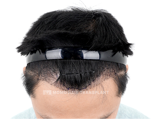 Forehead reduction scar cover incisional hair transplant before